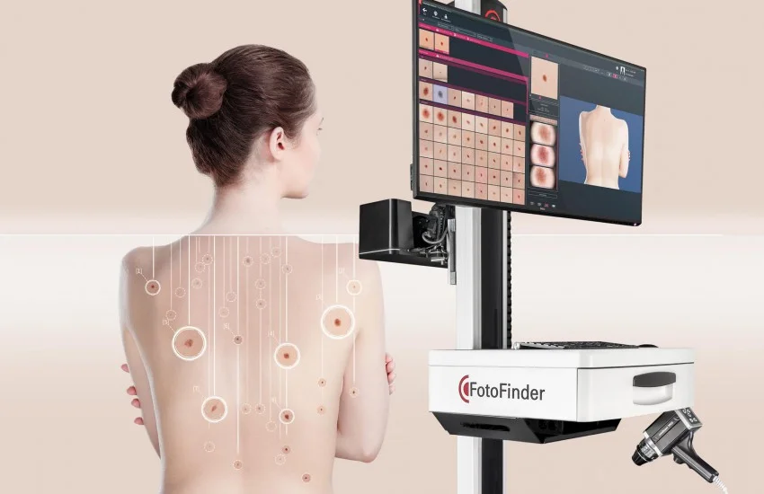 DIAGNOSTIC OF SKIN MOLES BY DOCTORS AND BY AI